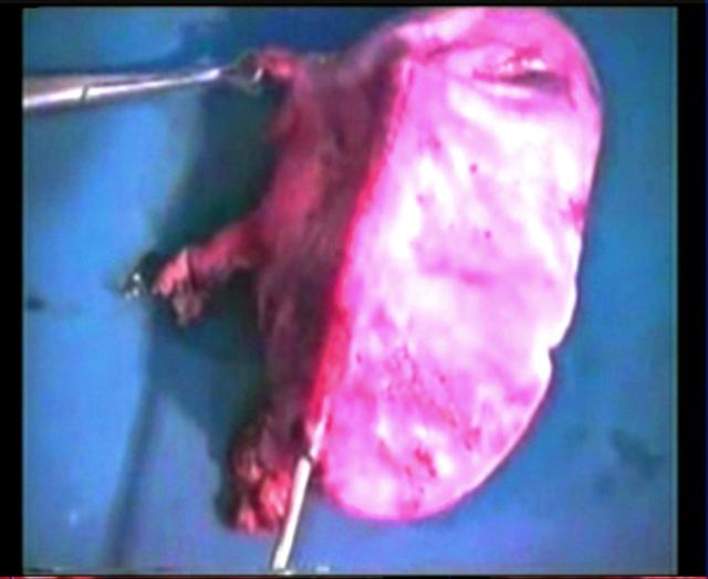 A large unilocular ovarian cyst 20 weeks size,aspirated 